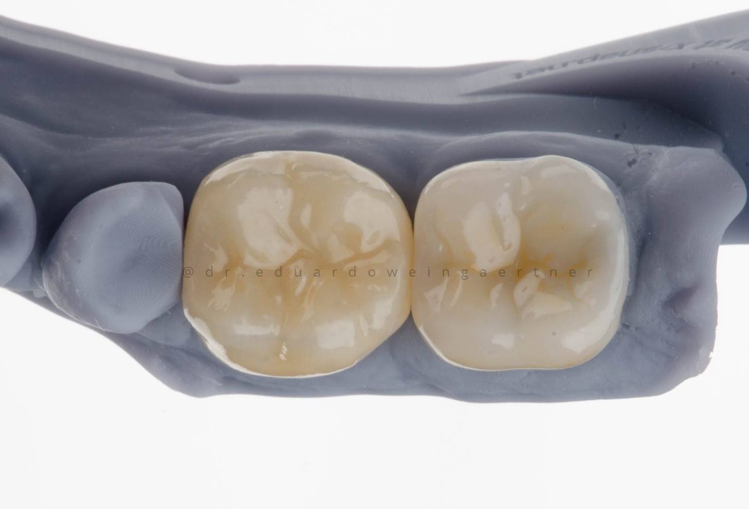 Coroa de Porcelana sobre Implante